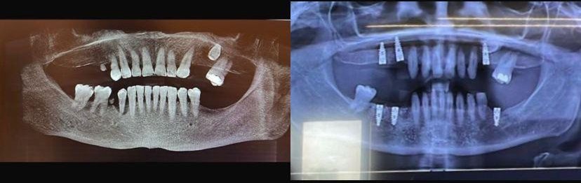 Case 1: panoramic radiograph before and after treatment, Health Point Albania Tirana