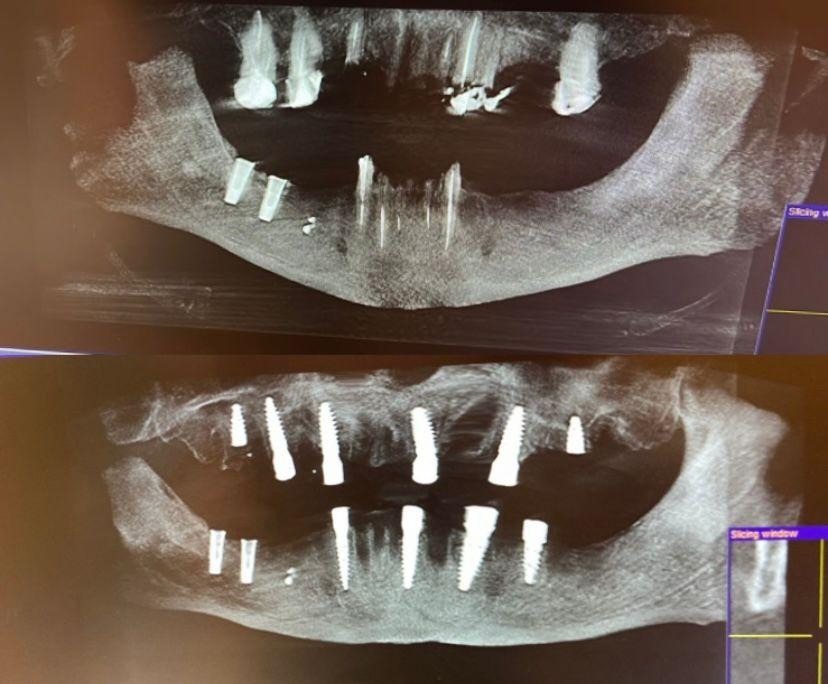 Case 2: panoramic radiograph before and after treatment, Health Point Albania Tirana