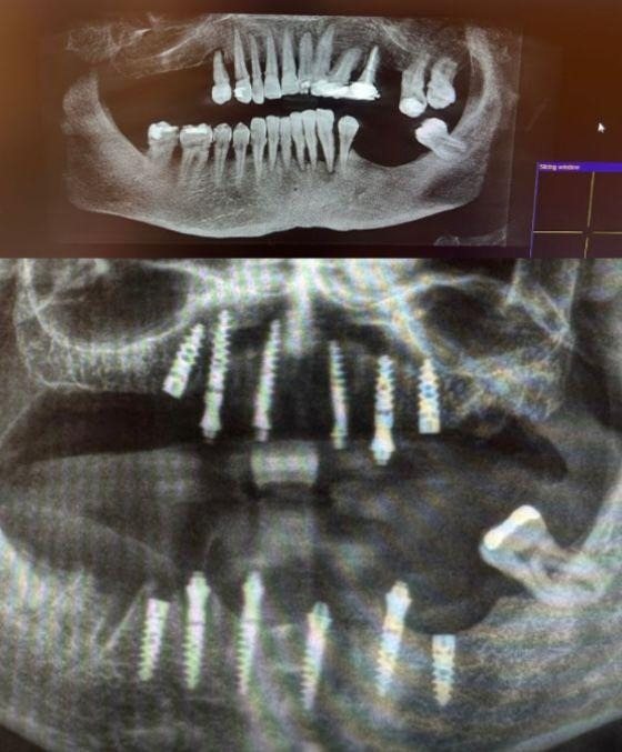 Case 3: panoramic radiograph before and after treatment, Health Point Albania Tirana