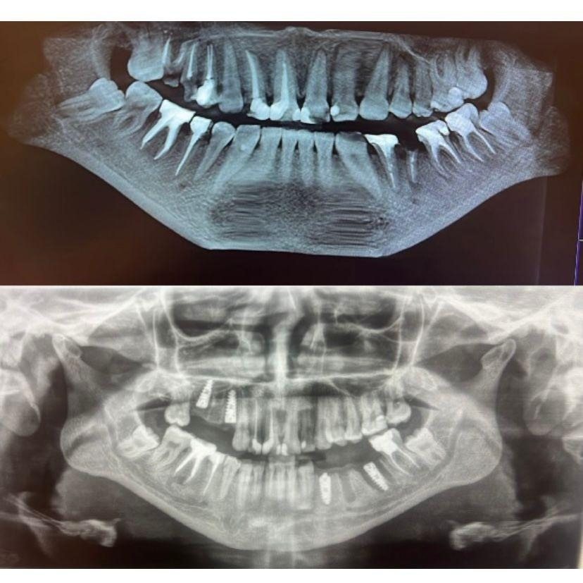 Case 4: panoramic radiograph before and after treatment, Health Point Albania Tirana