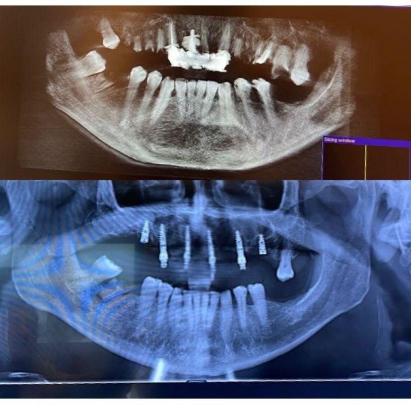 Case 5: panoramic radiograph before and after treatment, Health Point Albania Tirana