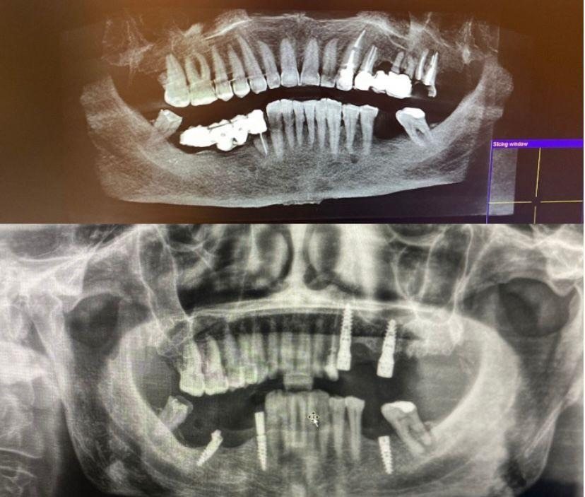 Case 6: panoramic radiograph before and after treatment, Health Point Albania Tirana