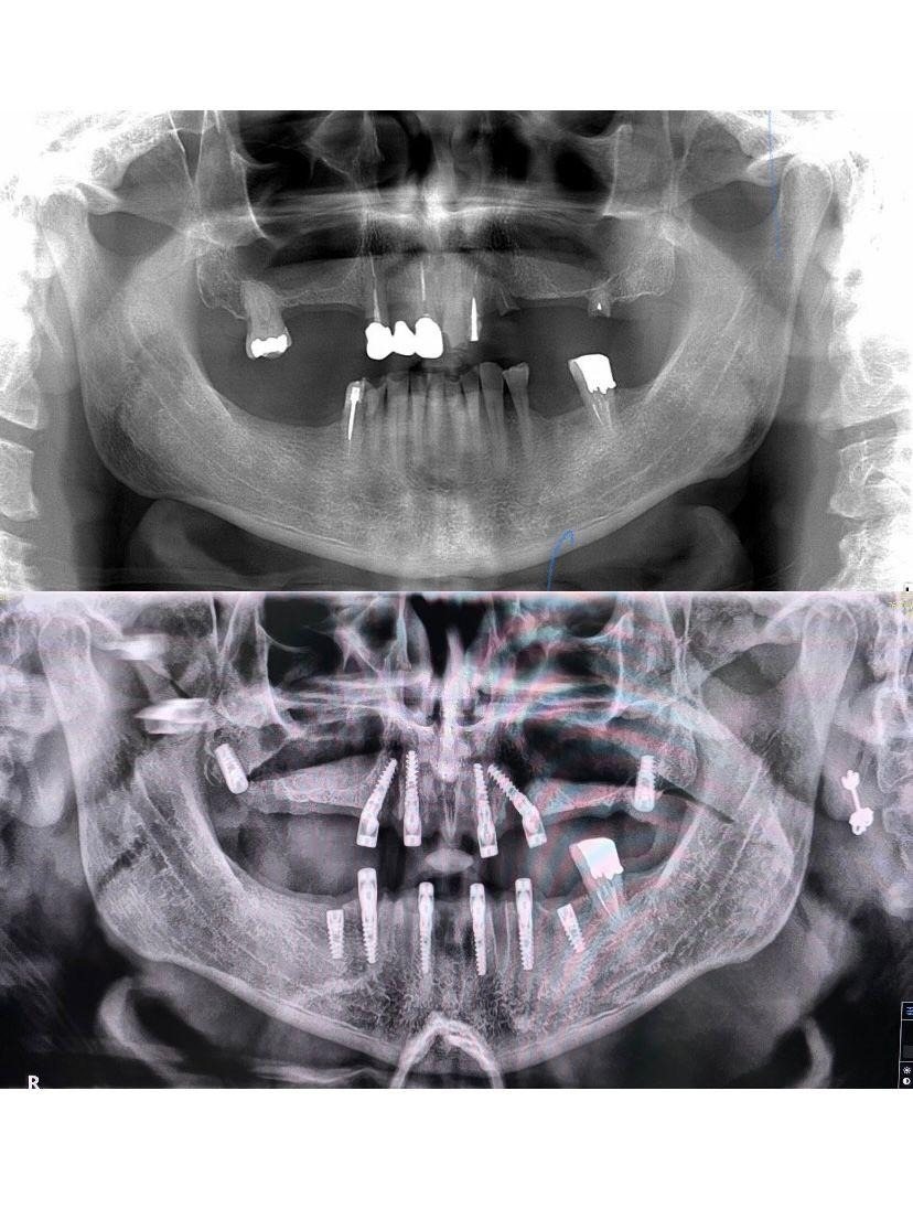 Case 7: panoramic radiograph before and after treatment, Health Point Albania Tirana