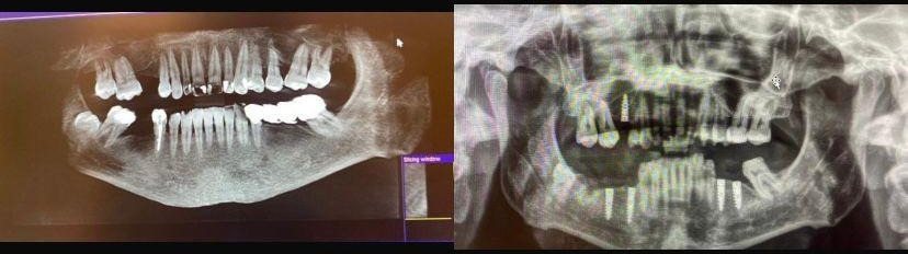 Case 10: panoramic radiograph before and after treatment, Health Point Albania Tirana