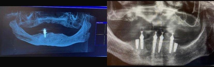 Case 13: panoramic radiograph before and after treatment, Health Point Albania Tirana