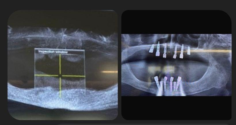 Case 16: panoramic radiograph before and after treatment, Health Point Albania Tirana