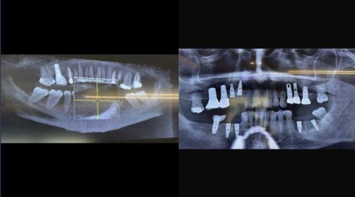 Case 17: panoramic radiograph before and after treatment, Health Point Albania Tirana