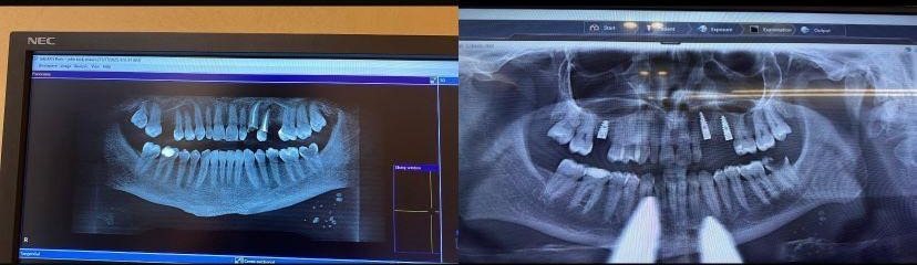 Case 18: panoramic radiograph before and after treatment, Health Point Albania Tirana