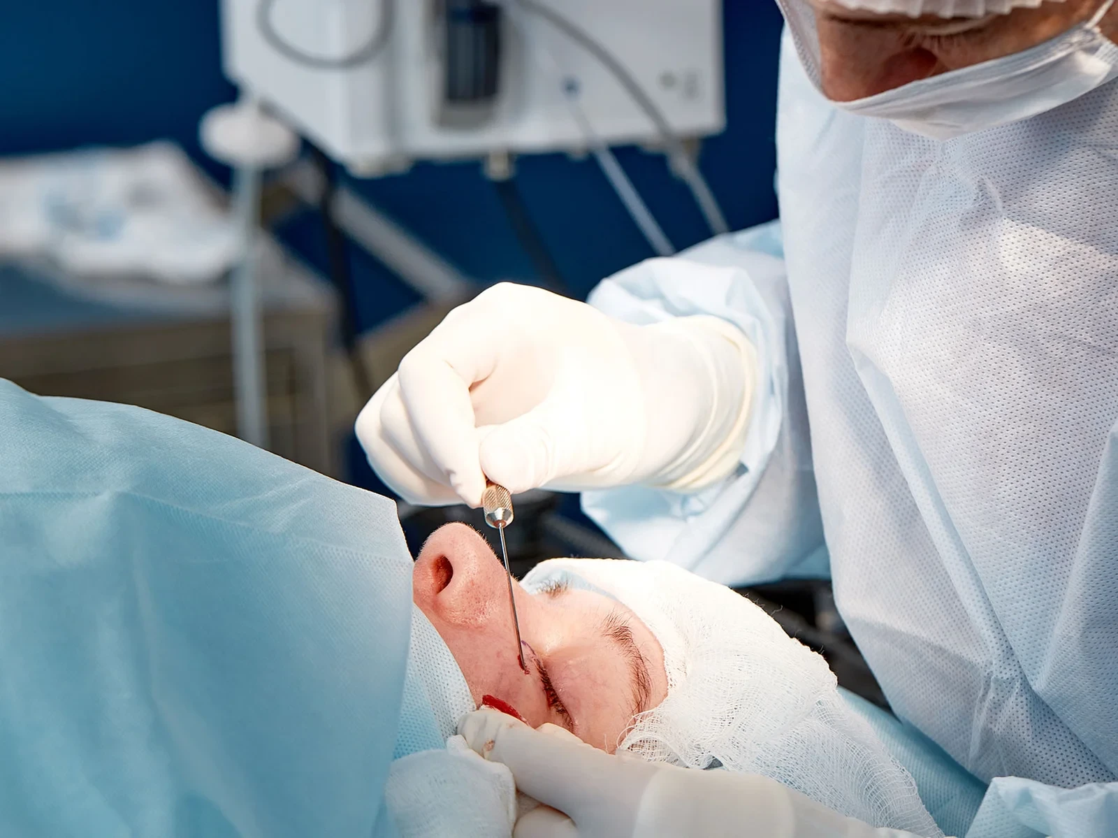 Rinoplastikë gjatë ndërhyrjes